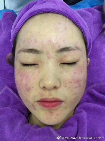 驻马店痘痘祛除项目加盟，打造美丽自信新风尚