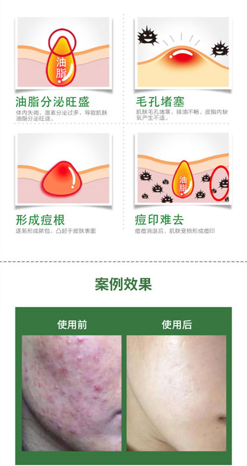 郑州祛痘项目加盟价格分析