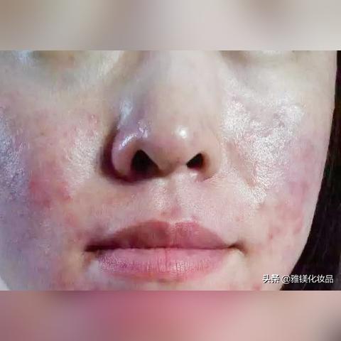 红敏皮面膜大揭秘，女士专用，舒缓修复，这些品牌值得你拥有！