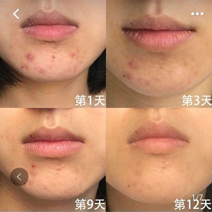 告别痘痘困扰，这些祛痘修护面膜让你肌肤焕发光彩！