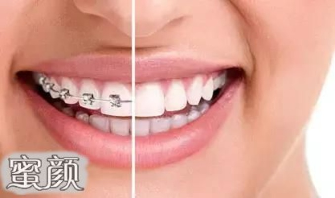 揭秘高端陶瓷牙套品牌排行，美丽笑容从此不再遥远！