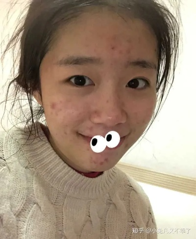 平价又有效的祛痘印面膜推荐，告别痘印困扰！