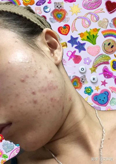 平价又有效的祛痘印面膜推荐，告别痘印困扰！