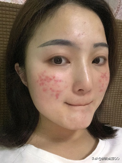 儿童专用祛痘面膜大推荐，温和护肤，告别青春痘烦恼