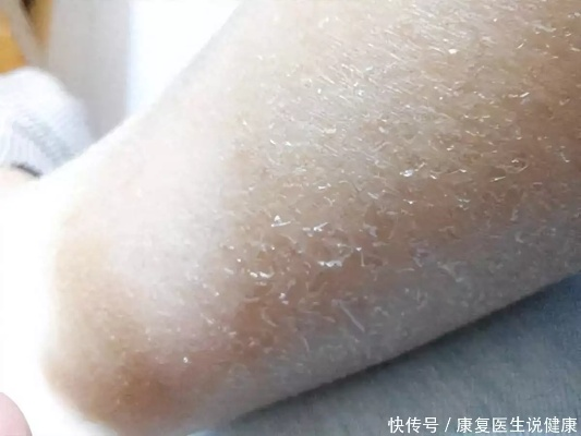 身上皮肤痒，盖鸭绒被可行吗？全方位解答你的疑问