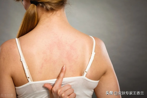身上皮肤痒，盖鸭绒被可行吗？全方位解答你的疑问