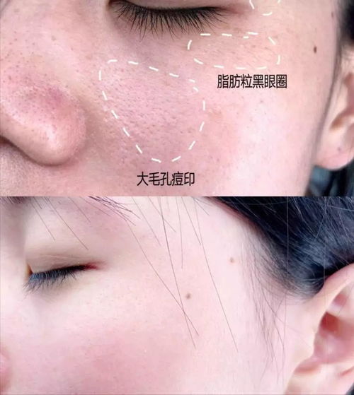 急救+平价！这8款面膜专治痘印，学生党也能轻松get好皮肤