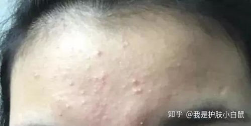 湿敷去痘面膜推荐，平价好物大公开，你的痘痘克星在这里！