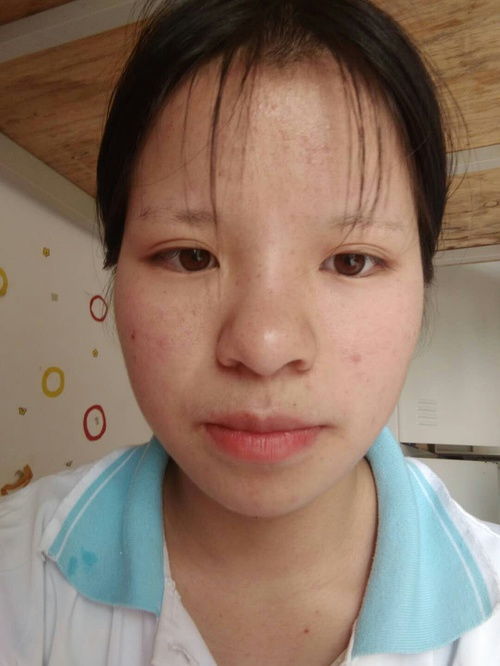 湿敷去痘面膜推荐，平价好物大公开，你的痘痘克星在这里！