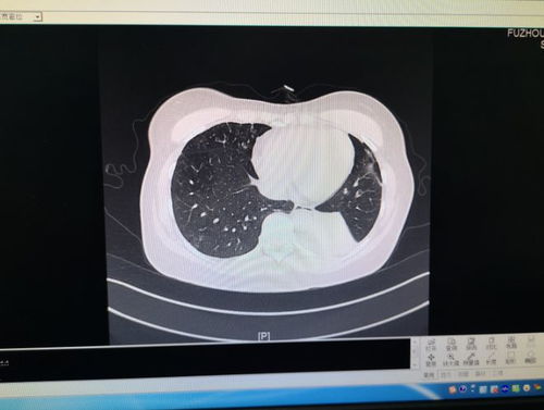 间质性肺炎患者睡鸭绒被，科学选择，健康无忧