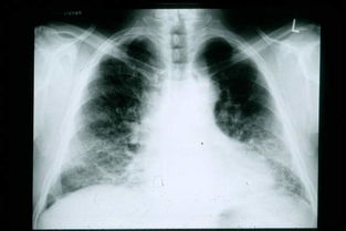 间质性肺炎患者睡鸭绒被，科学选择，健康无忧