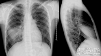 间质性肺炎患者睡鸭绒被，科学选择，健康无忧