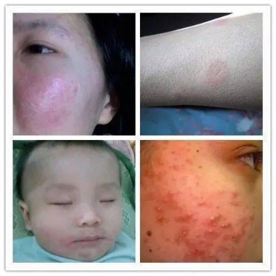 婴儿用鸭绒被过敏吗怎么办？5大疑问解答+真实案例+选购指南
