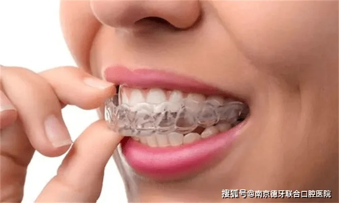 欧雅陶瓷牙套品牌疑问解答，价格、效果、适用人群全解析