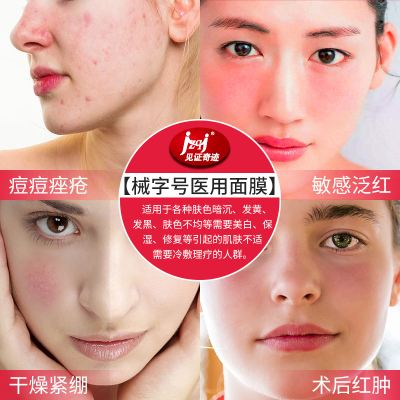什么祛痘面膜效果好 什么祛痘面膜效果好点