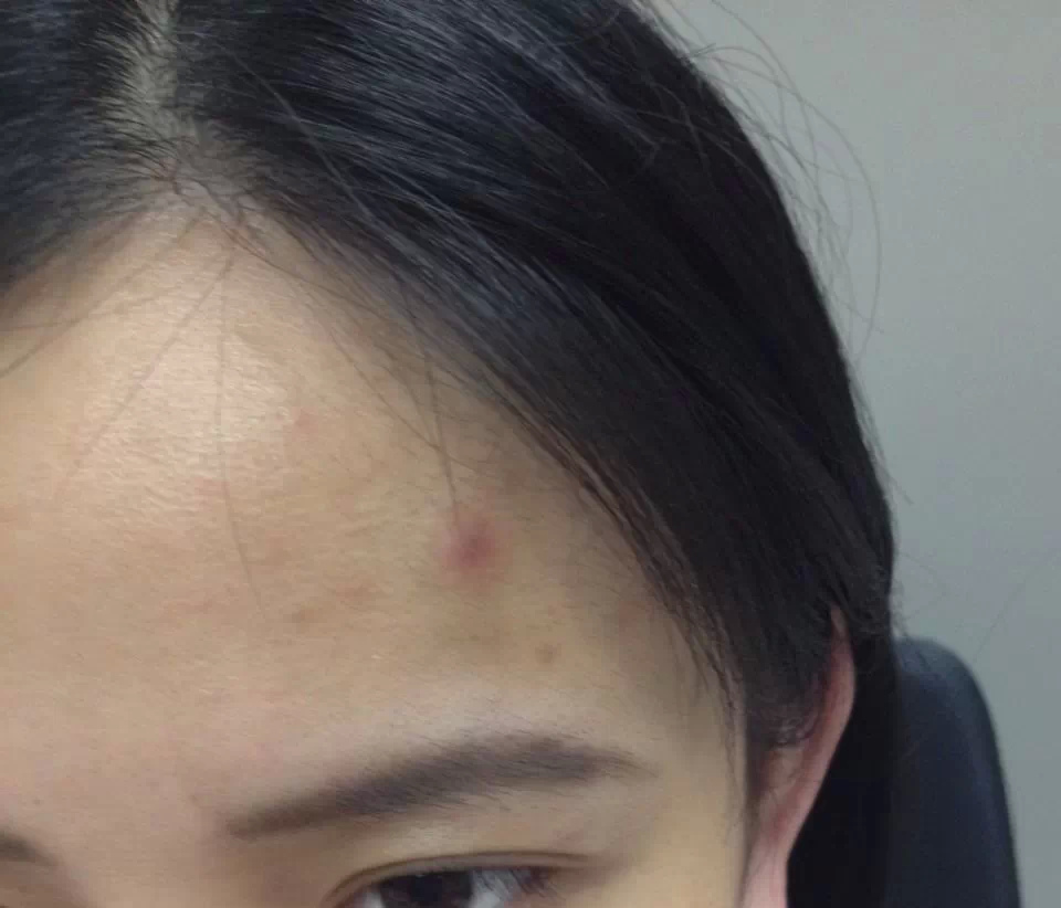 痘痘为什么会疼 痘痘为什么那么疼