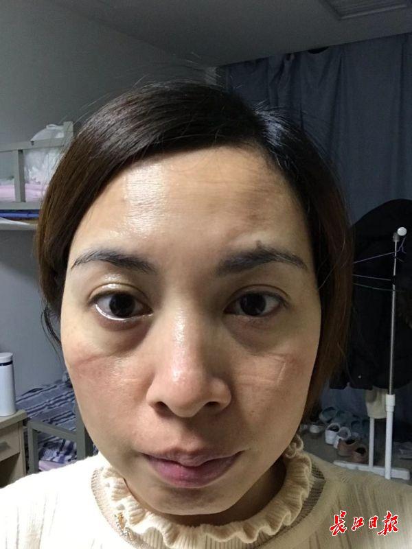 护士脸被口罩 医护人员用的口罩