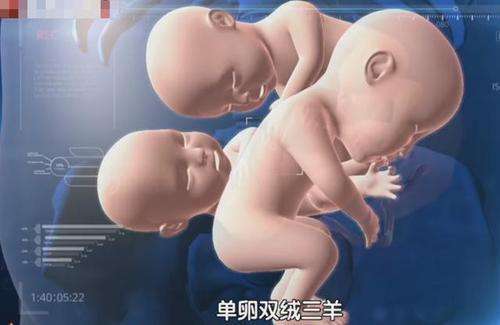 为什么会双胞胎 为什么会双胞胎一个有精神病另外那个也会有