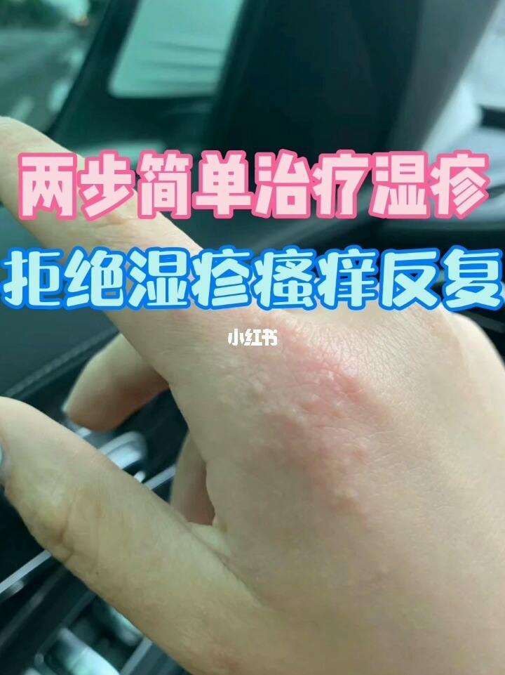 为什么湿疹反复发作 为什么湿疹反复发作淋巴结