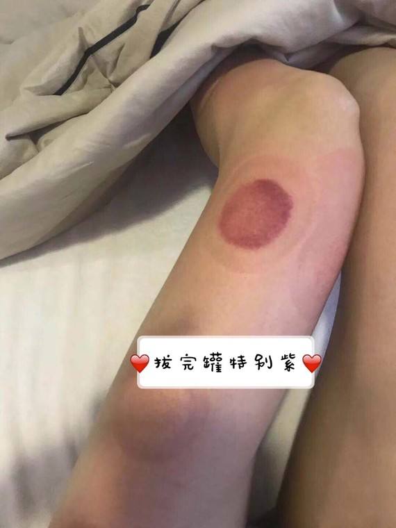 拔罐减肥反弹 拔罐减肥反弹吗?