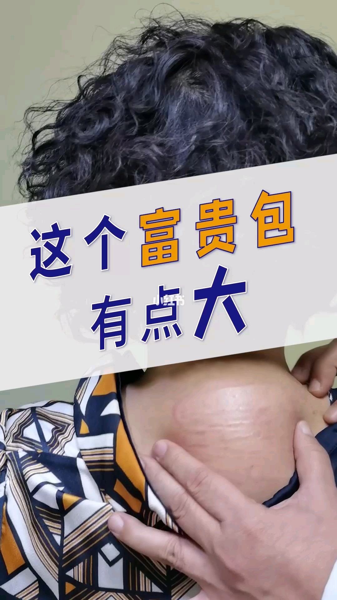 减肥能消除富贵包吗 减肥能消除富贵包吗知乎