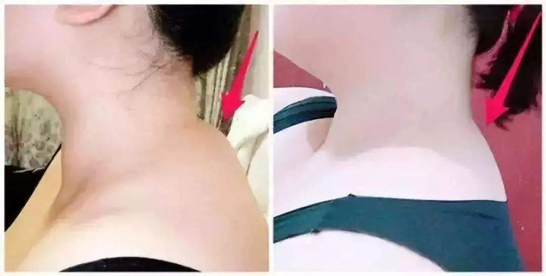 减肥能消除富贵包吗 减肥能消除富贵包吗知乎