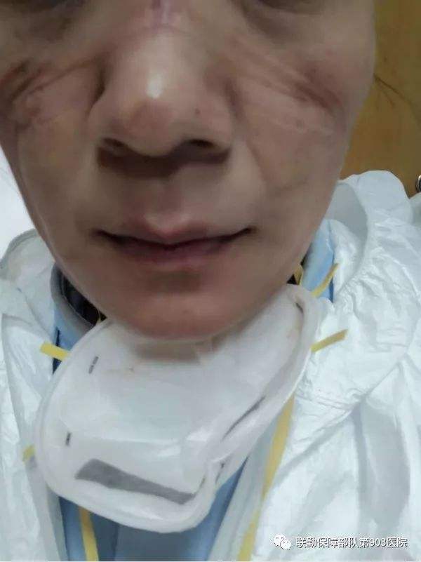 医生被口罩勒 医生被口罩勒的图片