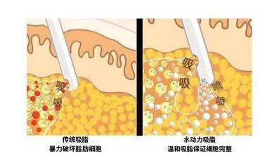 360度吸脂减肥 360吸脂减肥多少钱