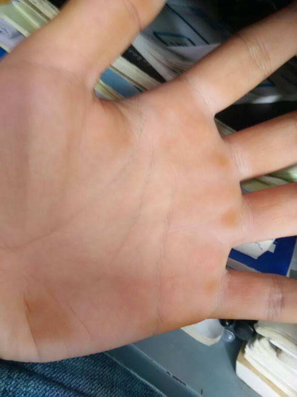 为什么手指发黄 为什么手指发黄麻痹