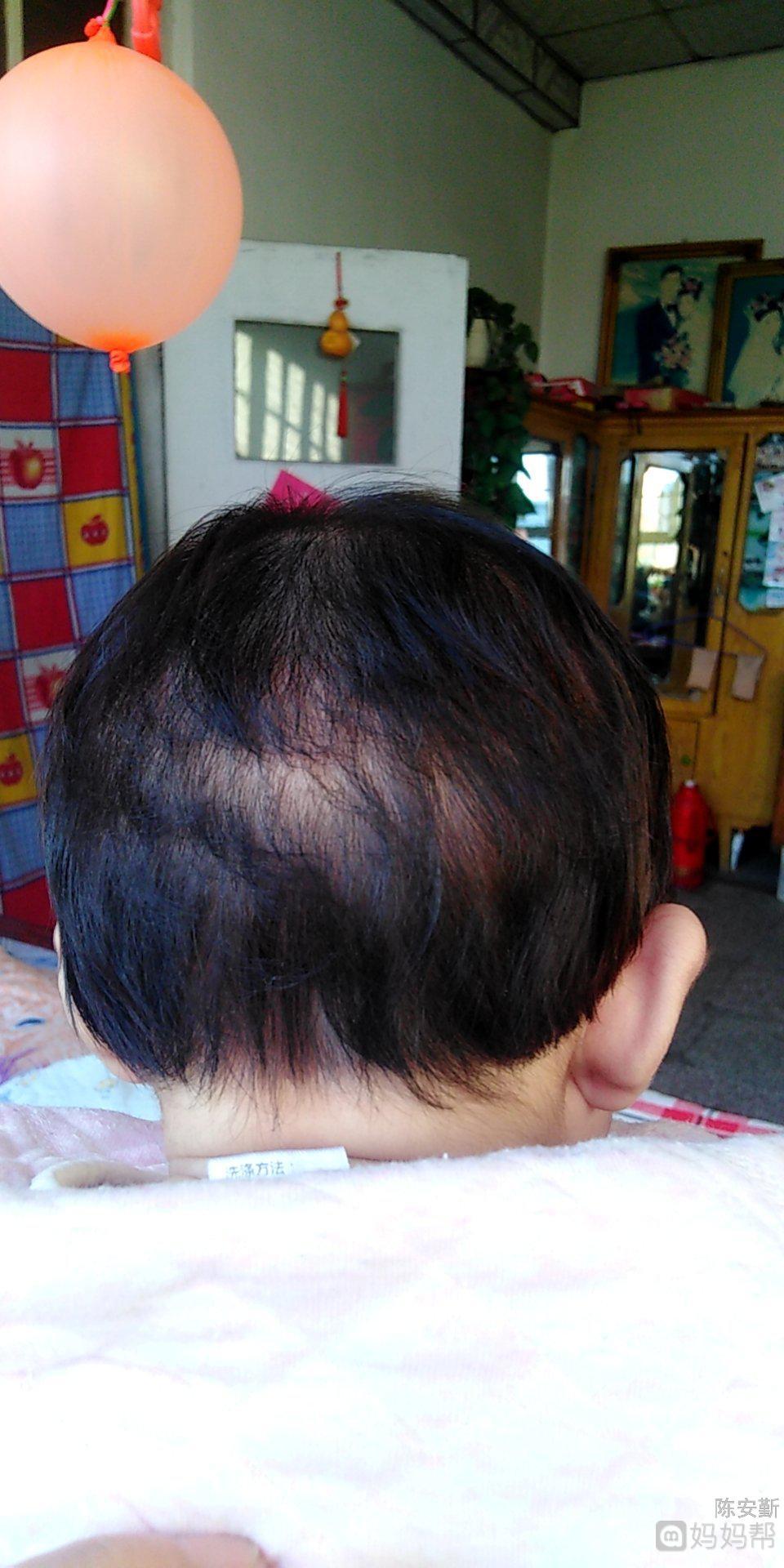 小孩后脑勺头发稀少为什么 小孩后脑勺头发稀少为什么会秃